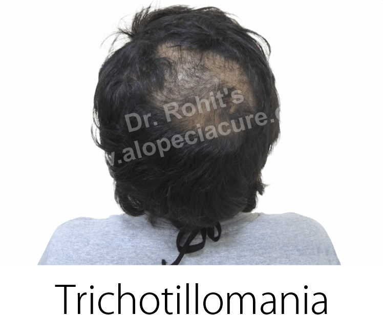 trichotillomania